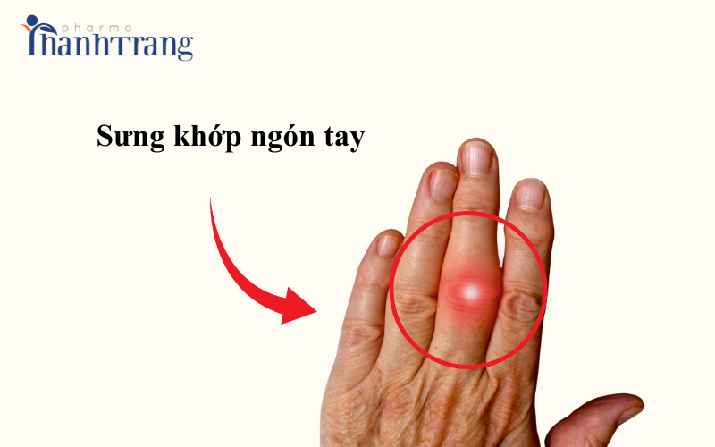 Sưng khớp ngón tay